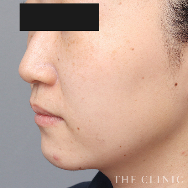 頰／顎のベイザー脂肪吸引（32歳女性）の術前写真