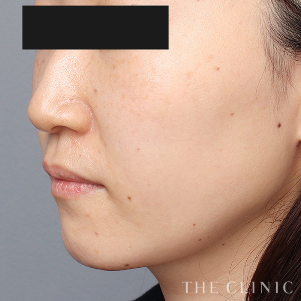 頰／顎のベイザー脂肪吸引（32歳女性）の術後写真