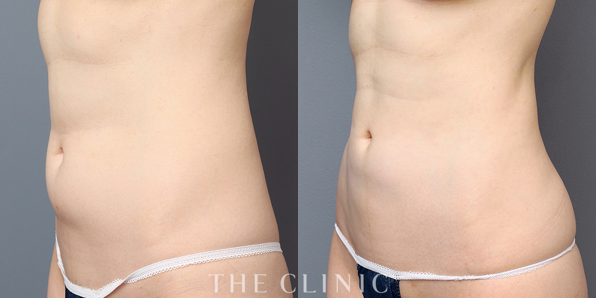 ベイザー脂肪吸引の術前／術後