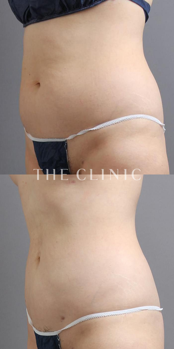 腹部のベイザー脂肪吸引（48歳女性）の術前・術後写真