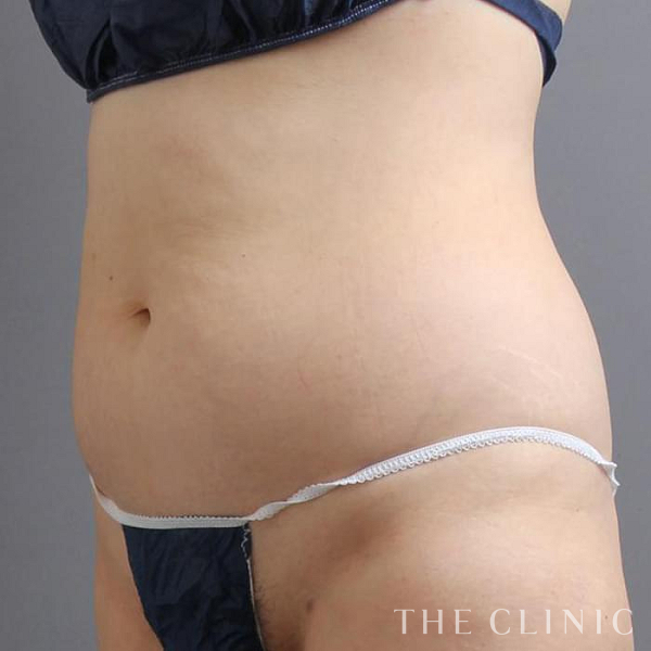 腹部のベイザー脂肪吸引（48歳女性）の術前写真