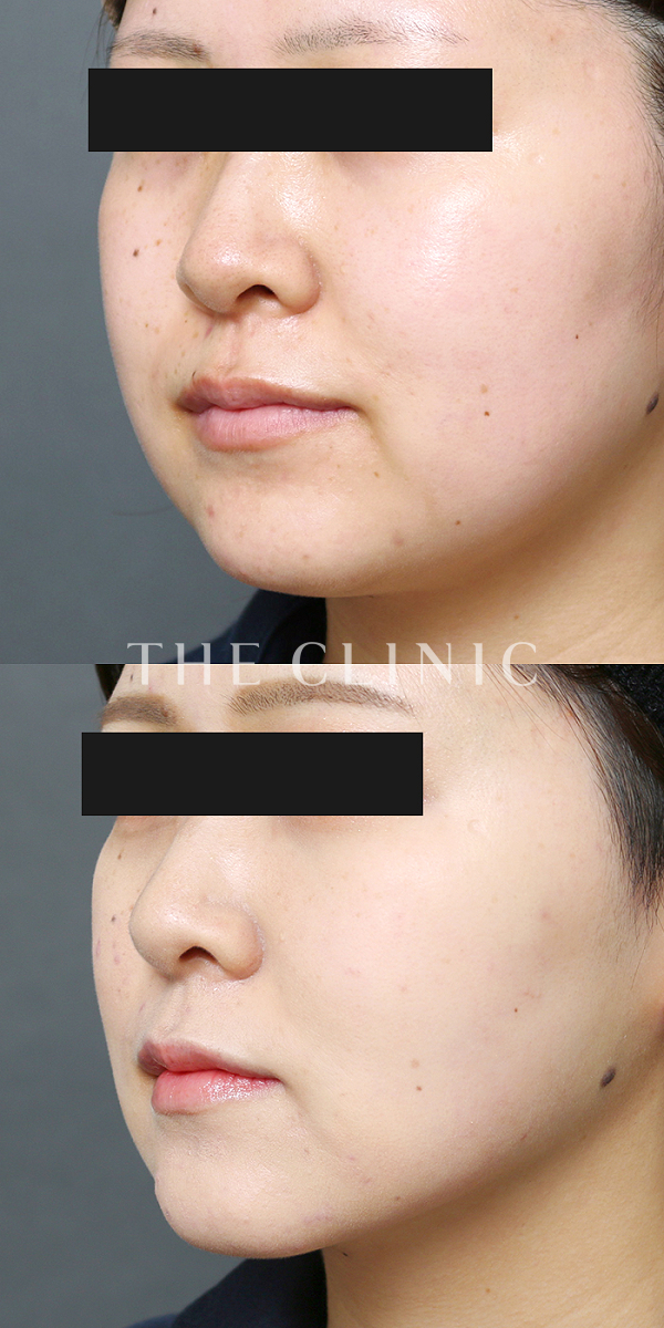 頰／顎のベイザー脂肪吸引（25歳女性）の術前・術後写真