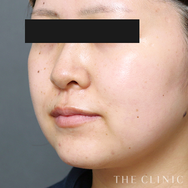 頰／顎のベイザー脂肪吸引（25歳女性）の術前写真