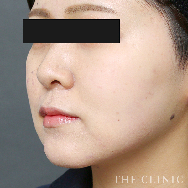 頰／顎のベイザー脂肪吸引（25歳女性）の術後写真