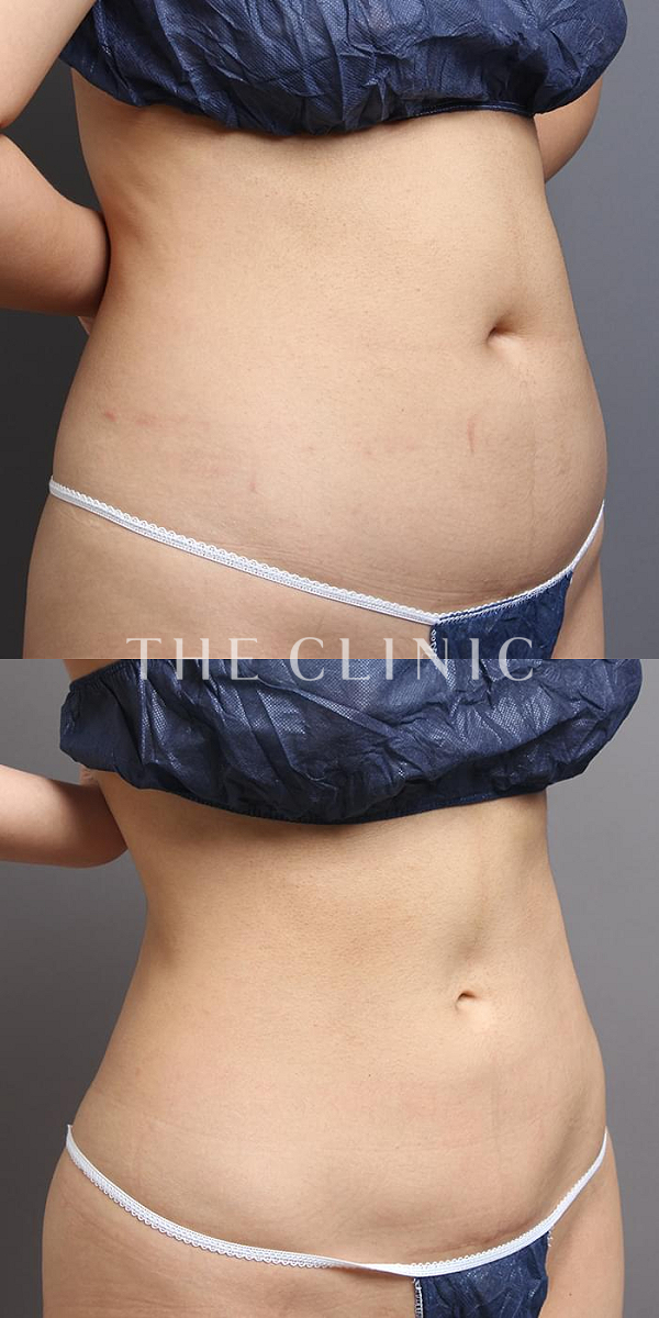 腹部のベイザー脂肪吸引（34歳女性）の術前・術後写真