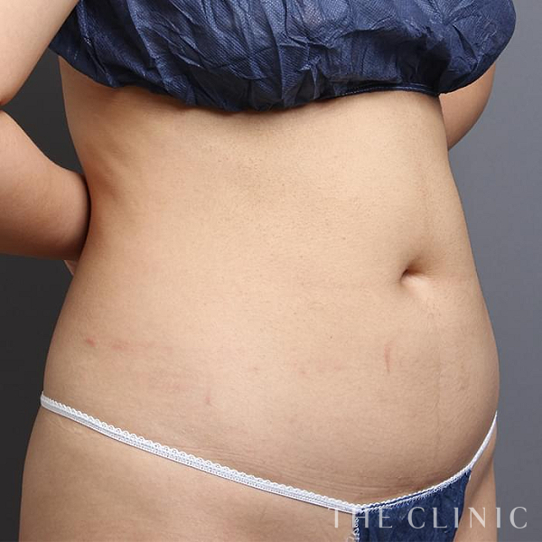 腹部のベイザー脂肪吸引（34歳女性）の術前写真