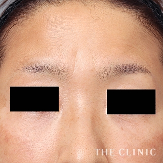 のコンデンスリッチフェイス(顔の脂肪注入)のモニター(40代)術前症例画像