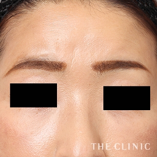 のコンデンスリッチフェイス(顔の脂肪注入)のモニター(40代)術後症例画像