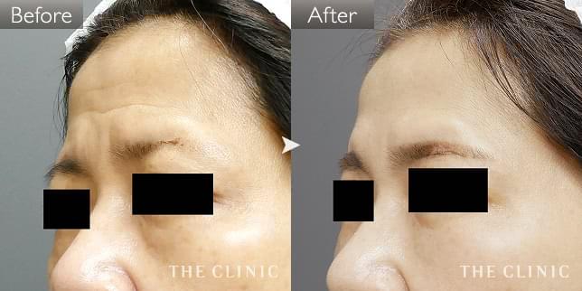 エイジング治療 眉間のシワ 症例写真