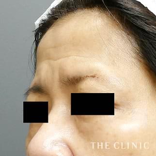 眉間のシワのボツリヌストキシン注入(ボトックス)のモニター(50代)術前症例画像