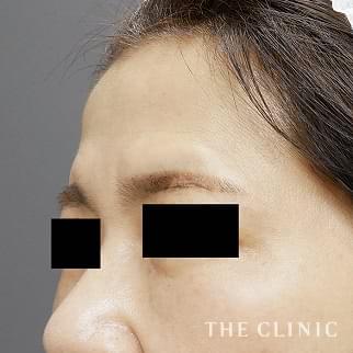眉間のシワのボツリヌストキシン注入(ボトックス)のモニター（50代）術後症例画像