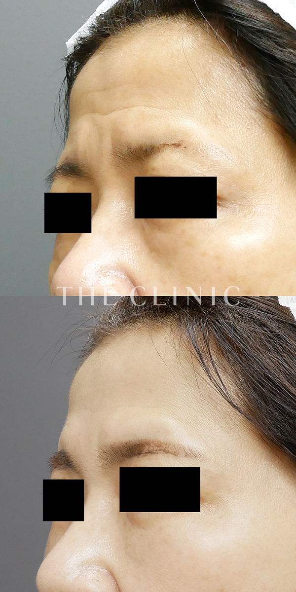 目の下のたるみのコンデンスリッチフェイス(顔の脂肪注入)（53歳女性）の術前・術後写真