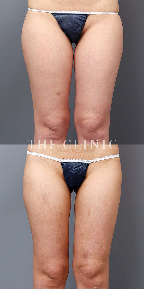 太もものベイザー脂肪吸引（23歳女性）の術前・術後写真