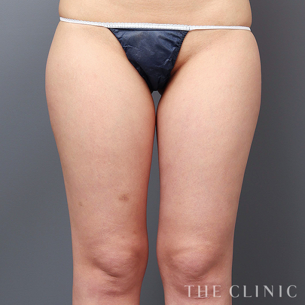 太もものベイザー脂肪吸引（23歳女性）の術前写真