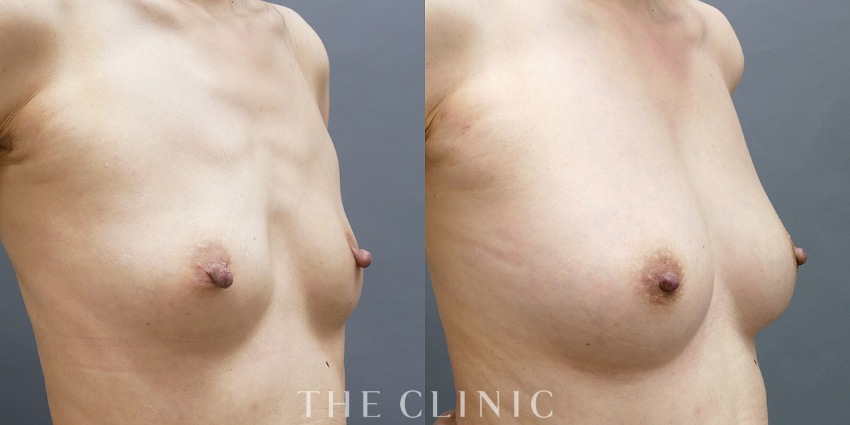 コンデンスリッチ豊胸の術前/術後