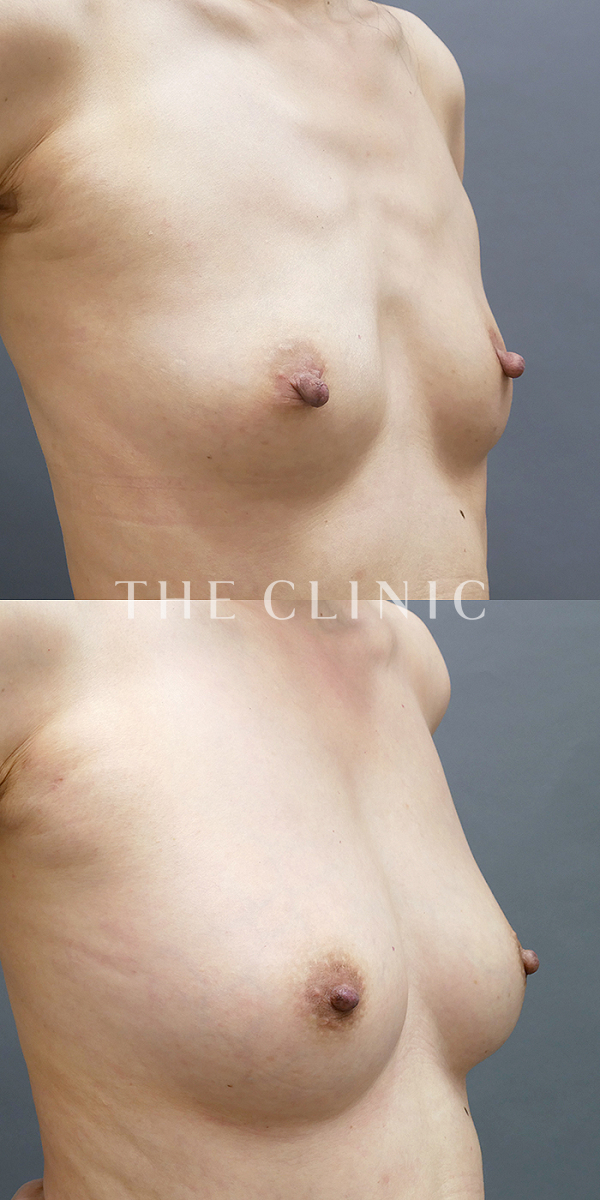 ボリュームアップのコンデンスリッチ豊胸（55歳女性）の術前・術後写真