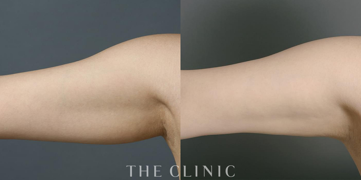 360脂肪吸引®の術前／術後