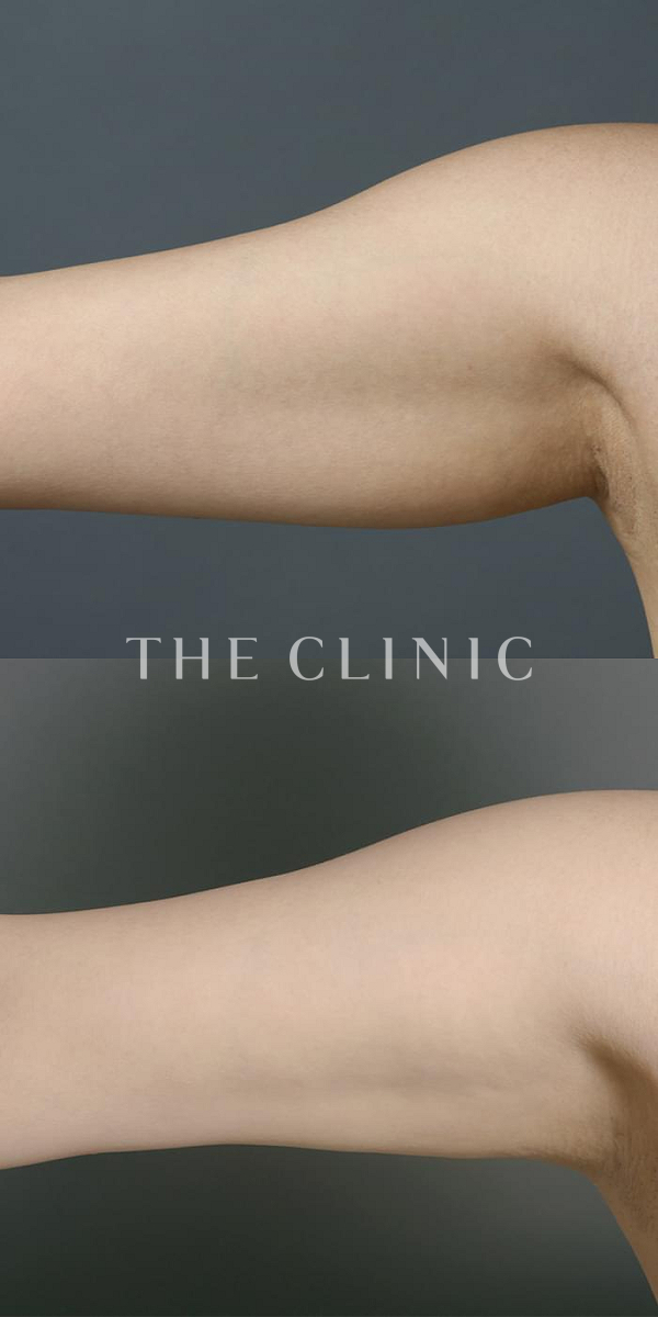 二の腕の360脂肪吸引®（36歳女性）の術前・術後写真