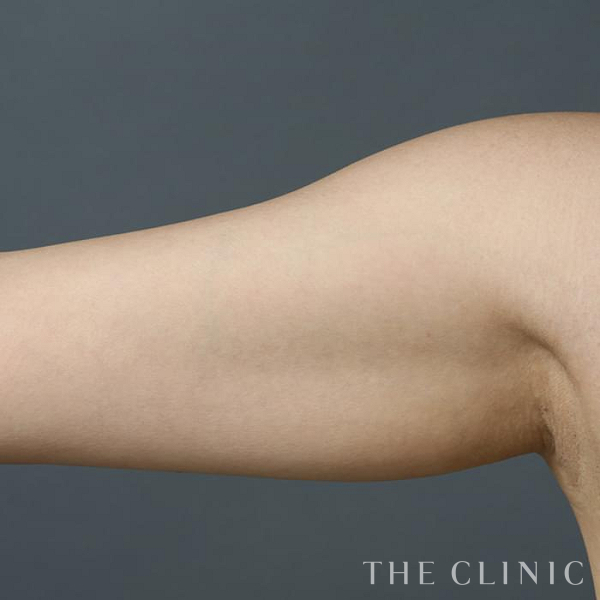 二の腕の360脂肪吸引®（36歳女性）の術前写真