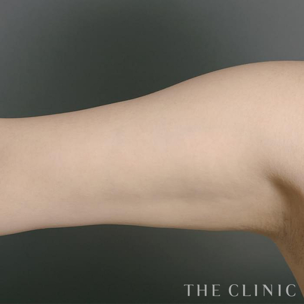 二の腕の360脂肪吸引®（36歳女性）の術後写真