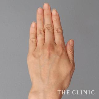 【THE CLINIC 症例画像】No.1200_1_手のシワ_手の甲への脂肪注入(ハンドリバイブ)(執刀医：今西 理也)