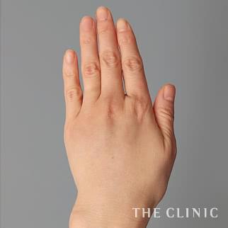 【THE CLINIC 症例画像】No.1200_2_手のシワ_手の甲への脂肪注入(ハンドリバイブ)(執刀医：今西 理也)