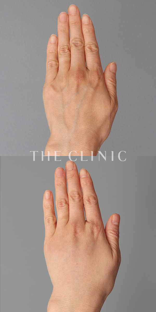 手のシワの手の甲への脂肪注入(ハンドリバイブ)（43歳女性）の術前・術後写真