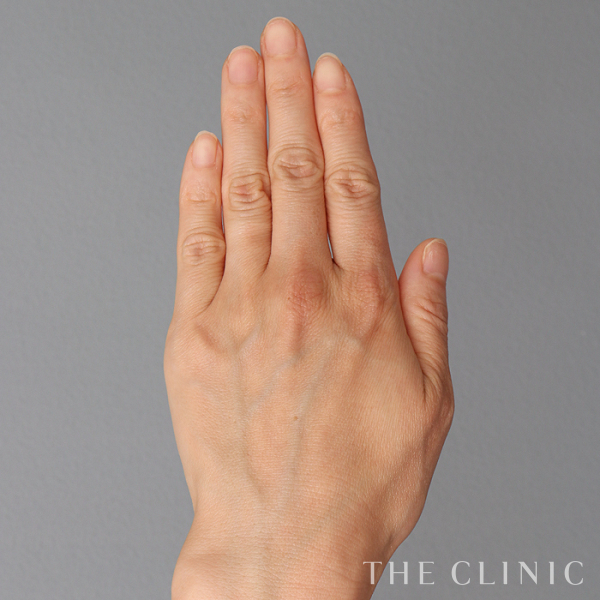 手のシワの手の甲への脂肪注入(ハンドリバイブ)（43歳女性）の術前写真