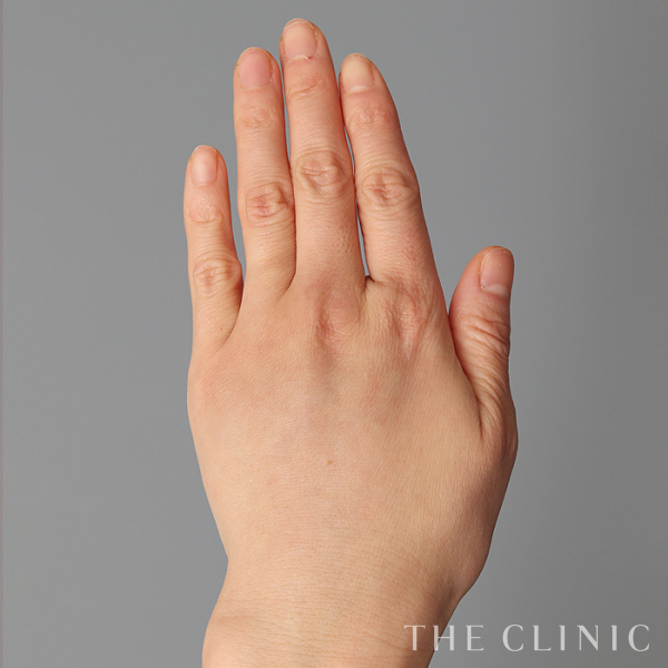 手のシワの手の甲への脂肪注入(ハンドリバイブ)（43歳女性）の術後写真