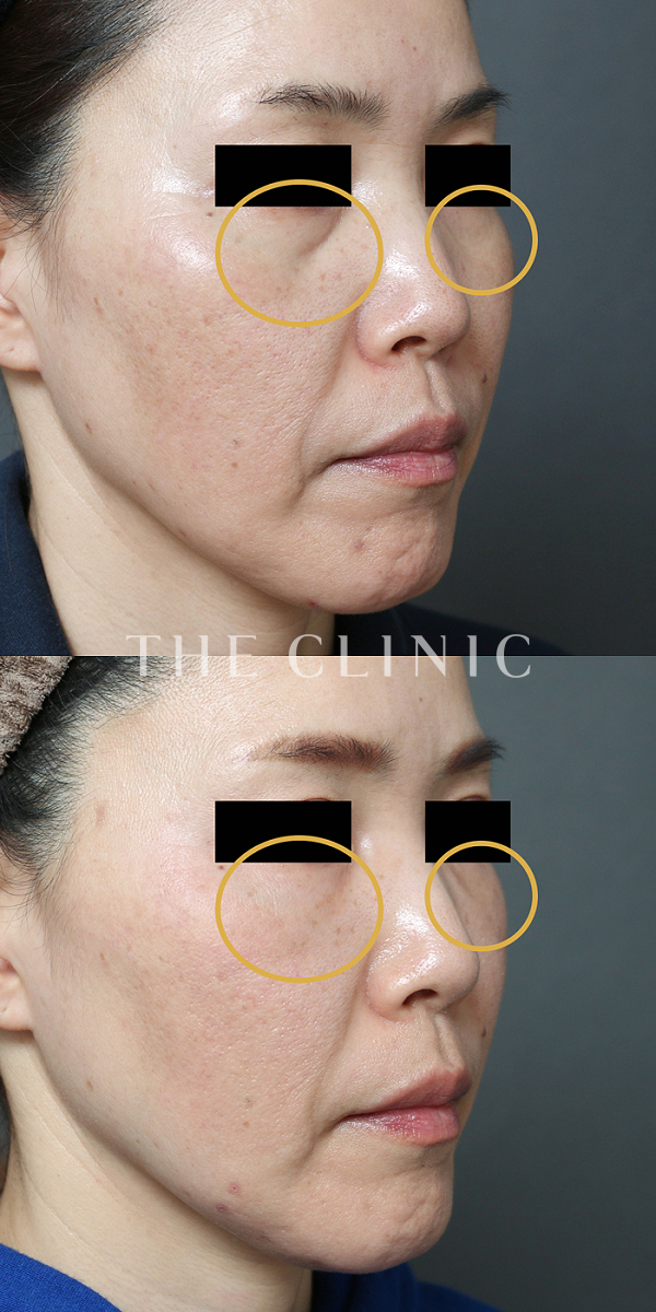 目の下のクマ・目の下のたるみのマイクロCRF注入(顔の脂肪注入)（48歳女性）の術前・術後写真