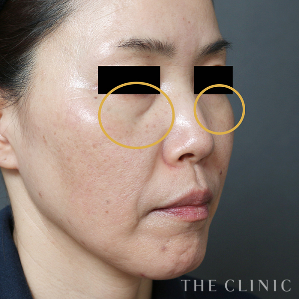 目の下のクマ・目の下のたるみのマイクロCRF注入(顔の脂肪注入)（48歳女性）の術前写真