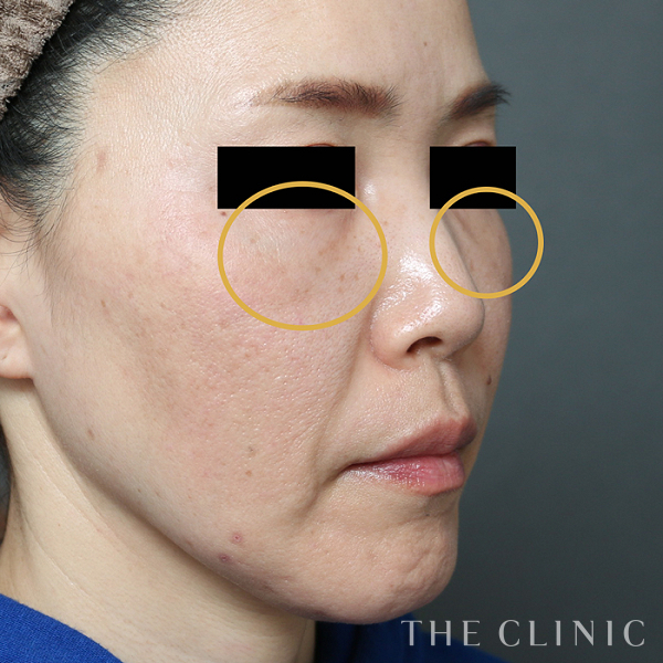 目の下のクマ・目の下のたるみのマイクロCRF注入(顔の脂肪注入)（48歳女性）の術後写真