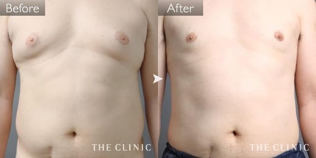 女性化乳房(男性/48歳)