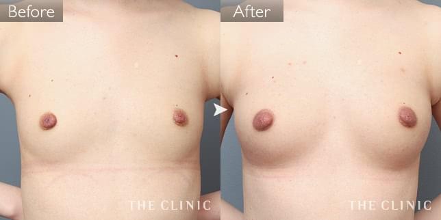 豊胸・胸の整形 ボリュームアップ 症例写真