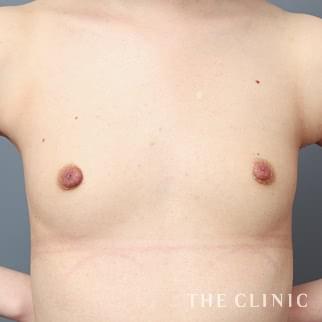 【THE CLINIC 症例画像】No.1212_1_ボリュームアップ_コンデンスビブラ豊胸(執刀医：帯包 雄次郎)