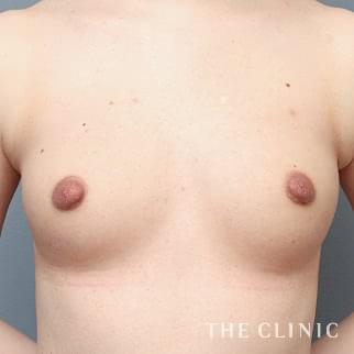 【THE CLINIC 症例画像】No.1212_2_ボリュームアップ_コンデンスビブラ豊胸(執刀医：帯包 雄次郎)