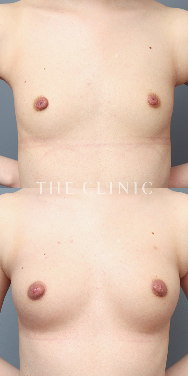 ボリュームアップのコンデンスビブラ豊胸（27歳女性）の術前・術後写真