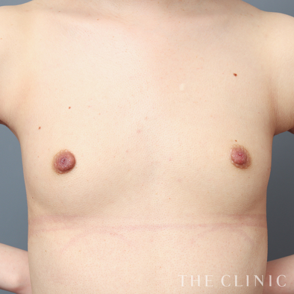 ボリュームアップのコンデンスビブラ豊胸（27歳女性）の術前写真