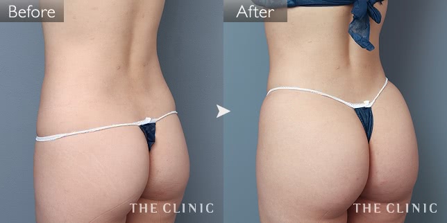 脂肪吸引 腹部/ボリュームアップ 症例写真