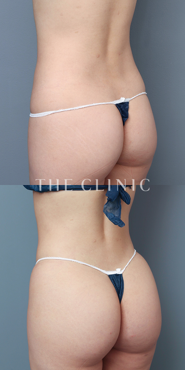 腹部・お尻・腰・ウエストのヒップメイク by 360脂肪吸引®（29歳女性）の術前・術後写真