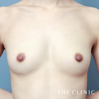 【THE CLINIC 症例画像】No.1218_1_ボリュームアップ_エクソソーム豊胸(執刀医:大橋 昌敬)