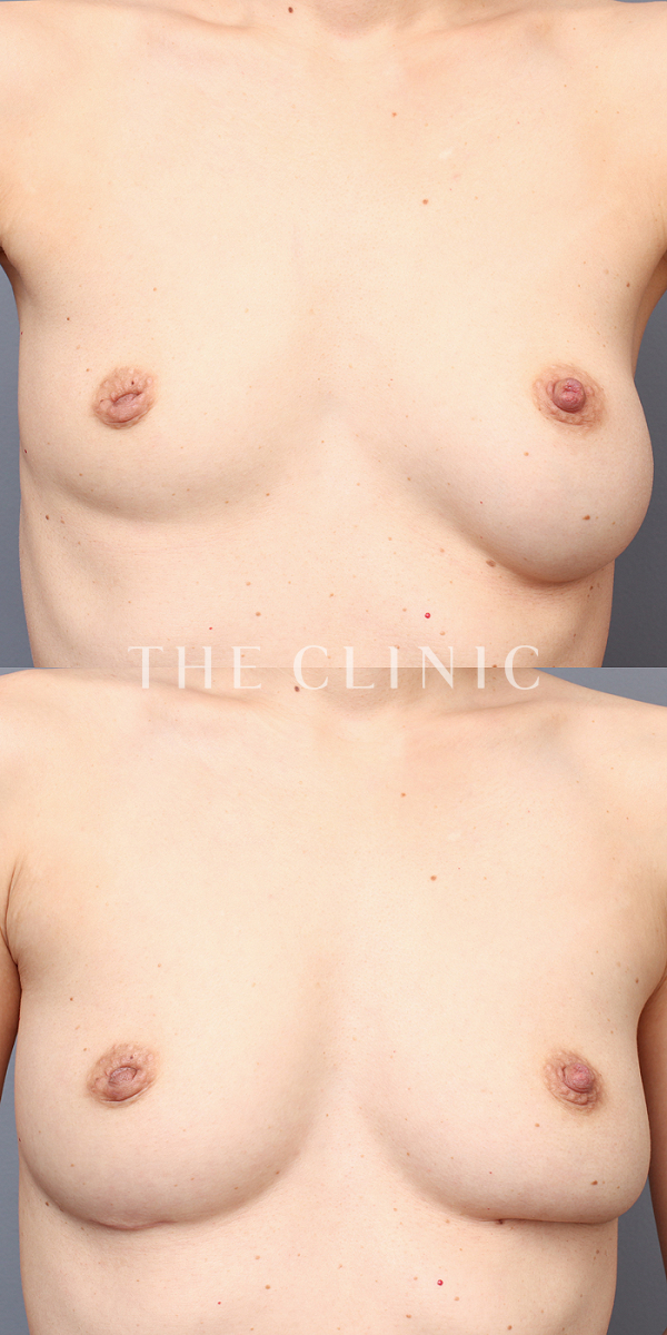 左右のバランスのエクソソーム豊胸（42歳女性）の術前・術後写真