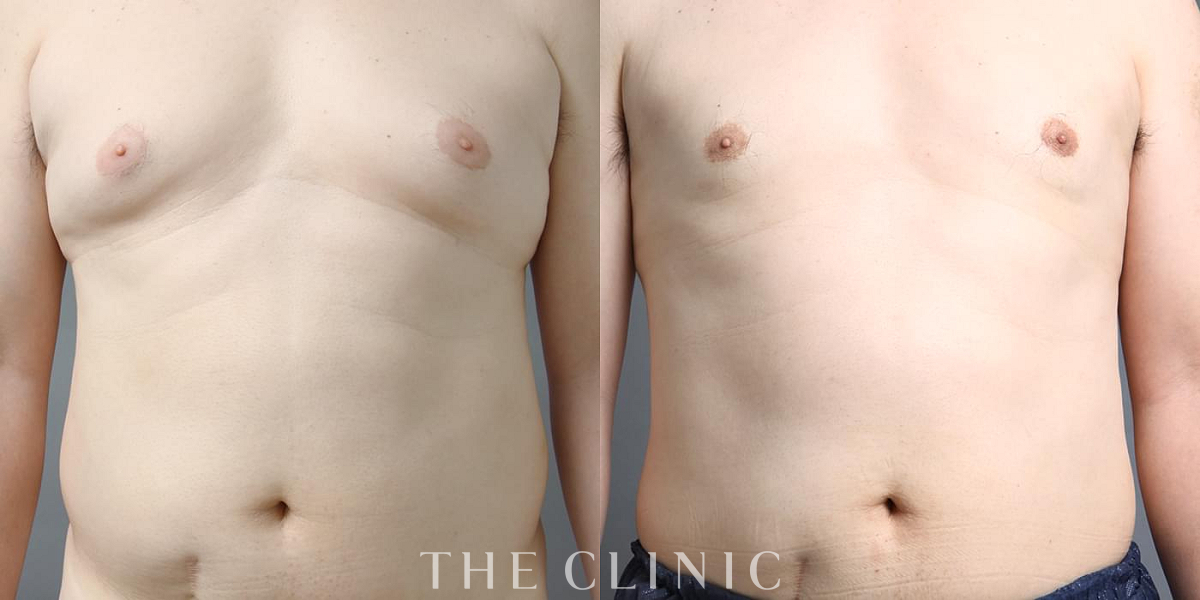 女性化乳房治療(男性の胸の膨らみ改善)の術前/術後