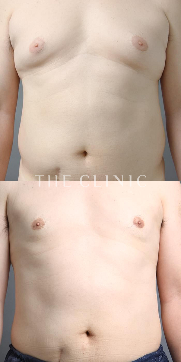 女性化乳房・偽性女性化乳房の女性化乳房治療(男性の胸の膨らみ改善)（48歳男性）の術前・術後写真