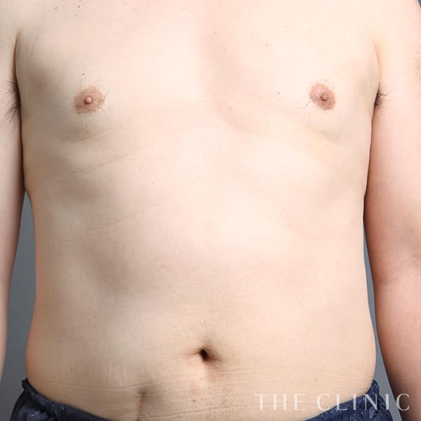 女性化乳房・偽性女性化乳房の女性化乳房治療(男性の胸の膨らみ改善)（48歳男性）の術後写真