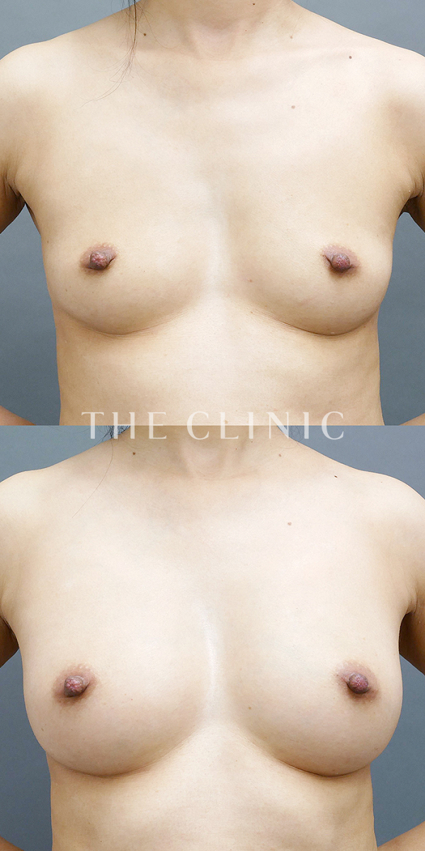 ボリュームアップのコンデンスリッチ豊胸（43歳女性）の術前・術後写真