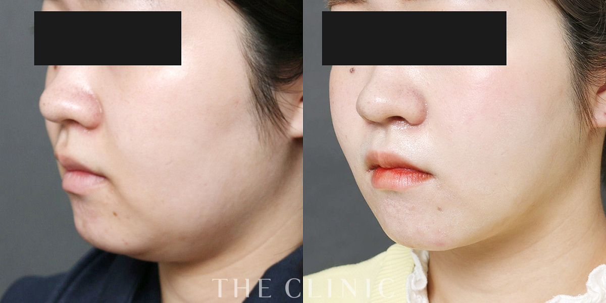 ベイザー脂肪吸引の術前／術後