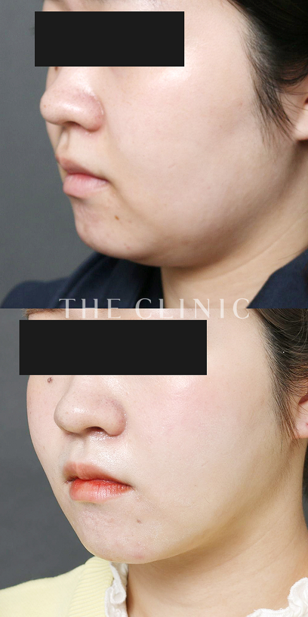 頰／顎のベイザー脂肪吸引（21歳女性）の術前・術後写真