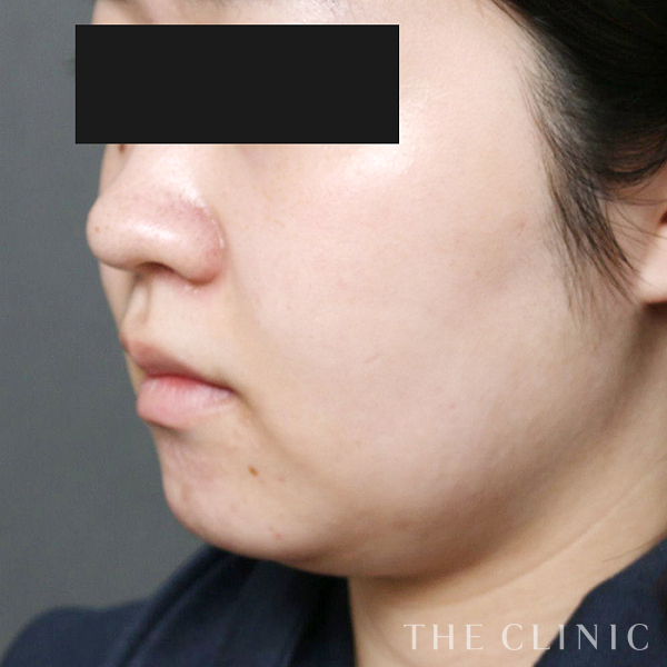 頰／顎のベイザー脂肪吸引（21歳女性）の術前写真