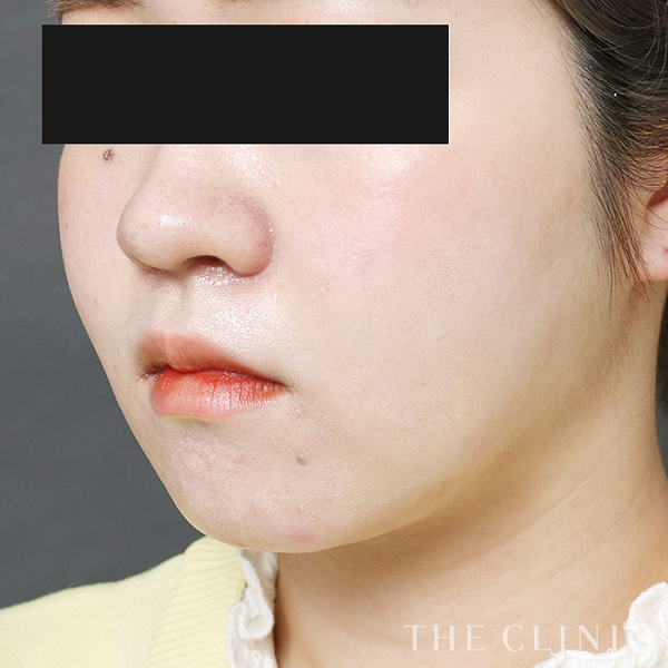 頰／顎のベイザー脂肪吸引（21歳女性）の術後写真